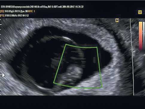 8 недель нет сердцебиения. УЗИ неразвивающейся беременности 8 недель. Замершая беременность УЗИ 8 недель. Неразвивающаяся беременность УЗИ. Неразвивающаяся беременность на ранних сроках УЗИ.